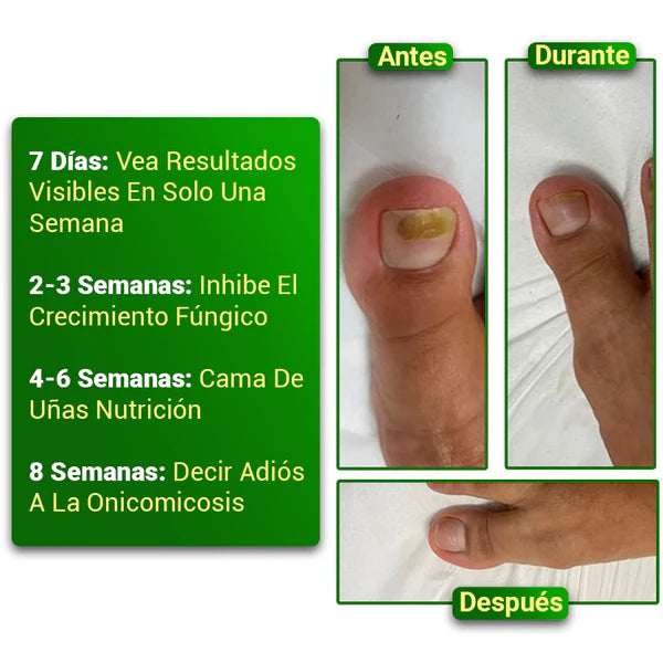 Aceite Jengibre Uñas